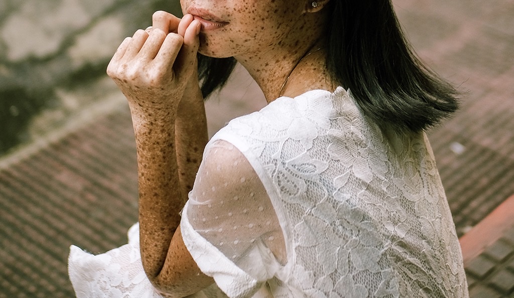 A woman with a skin condition